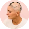 Cranial Prosthesis for Alopecia