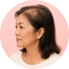 Cranial Prosthesis for Thinning Hair